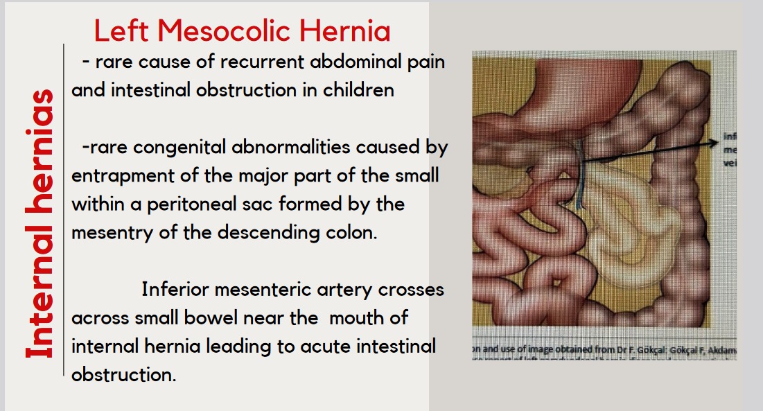 Left Mesocolic Hernia