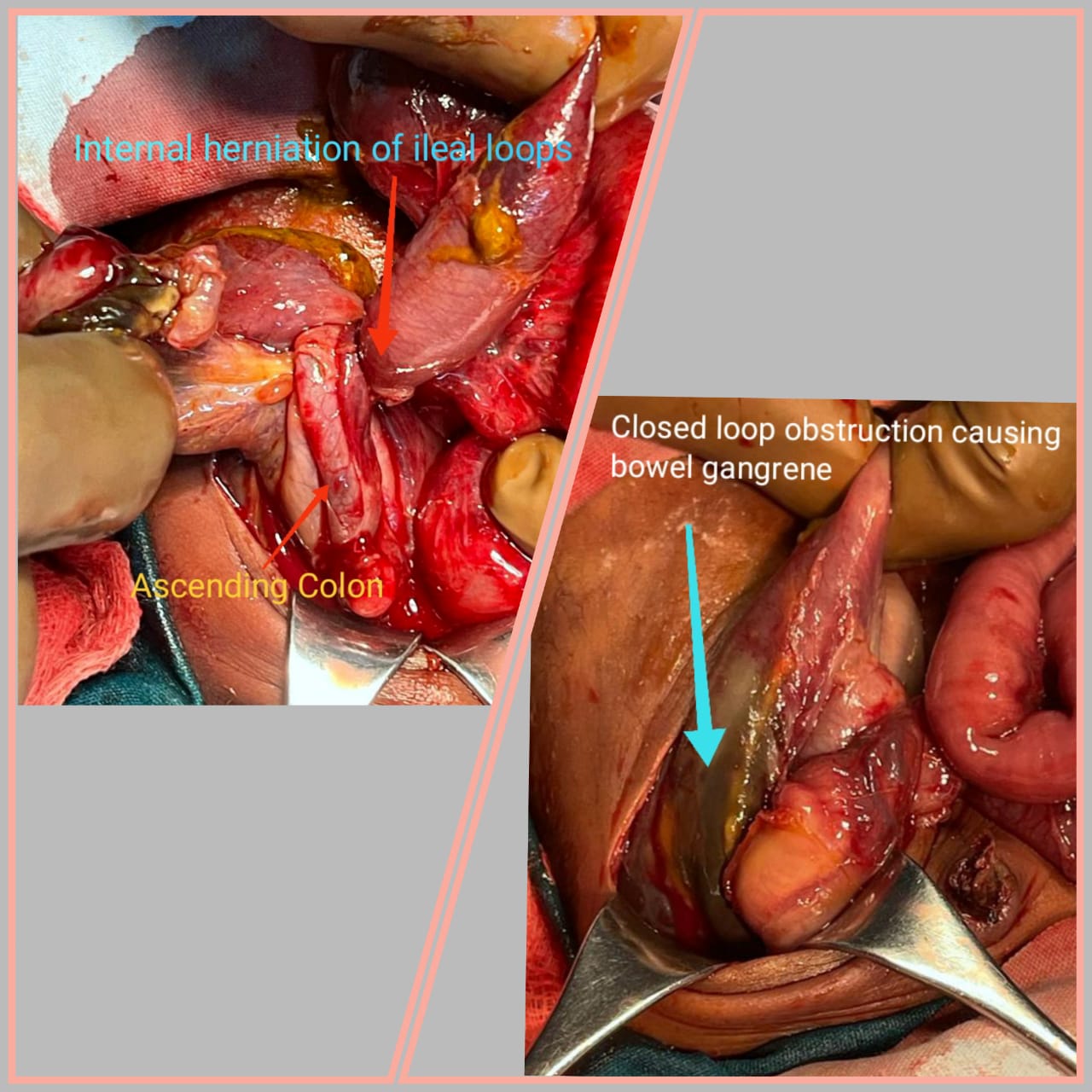 A Delicate Victory A Tiny Patient's Battle with a Rare Intestinal Disorder by Dr Arjun Pawar