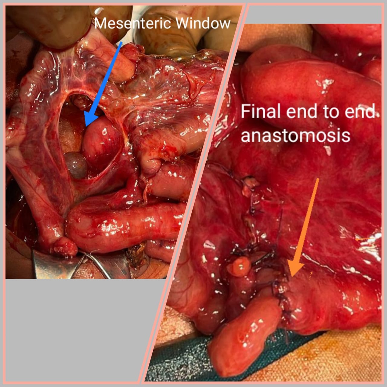 A Delicate Victory A Tiny Patient's Battle with a Rare Intestinal Disorder