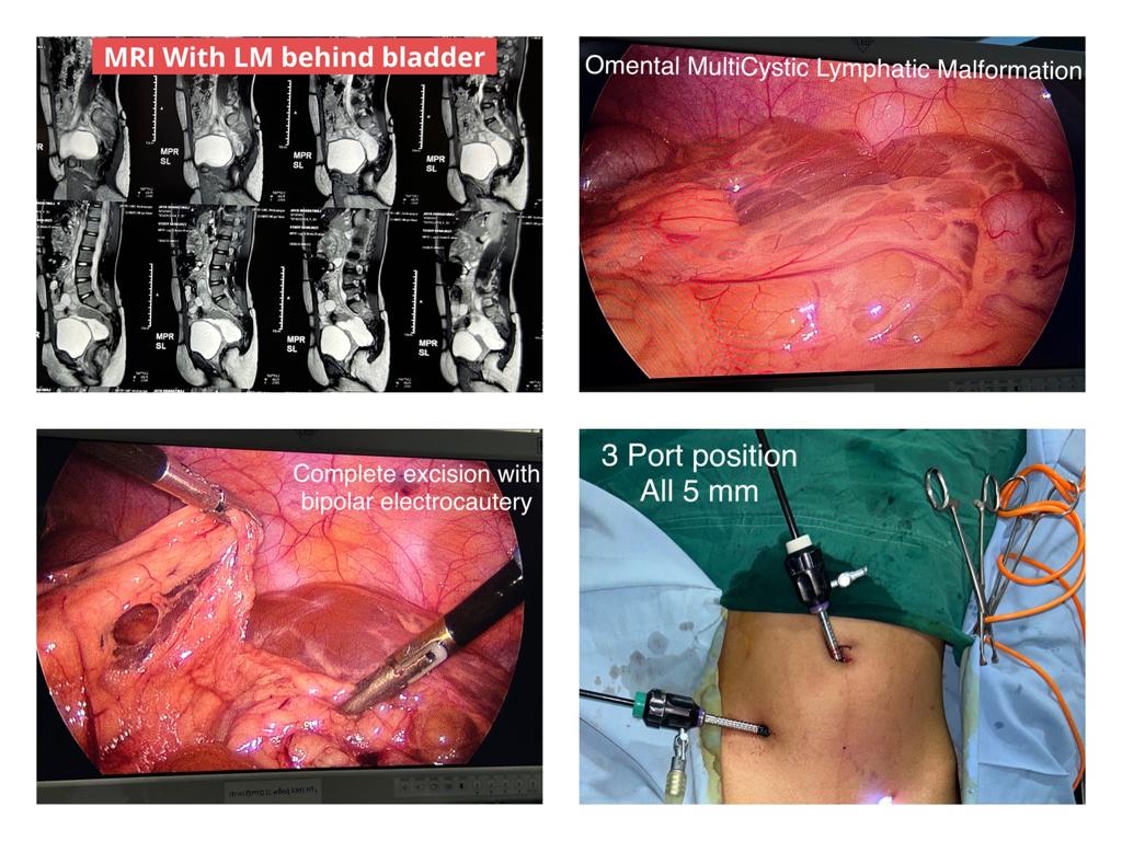 Laparoscopic Excision of a Giant Omental Lymphangioma A Rare Case